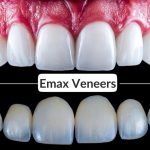 Exploring Emax Veneers: What Are Emax Veneers