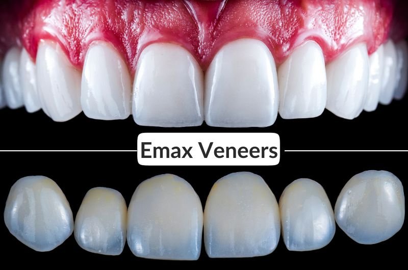 Exploring Emax Veneers: What Are Emax Veneers